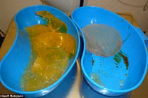 Suýt mất mạng vì nổ túi ngực silicone