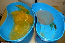 Suýt mất mạng vì nổ túi ngực silicone