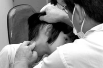 Bướu cổ đơn thuần là gì?