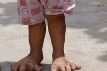 Bệnh lạ: Bé gái 3 tuổi mắc bệnh “bàn chân voi“