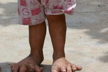 Bệnh lạ: Bé gái 3 tuổi mắc bệnh “bàn chân voi“