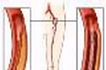Bệnh động mạch chi cần chữa thế nào?