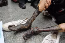 Nhiều trường hợp bệnh chân, tay “chết khô“