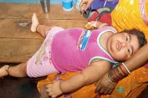 Bệnh lạ: Bé trai 18 tháng tuổi mọc ria như người lớn