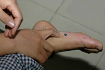 Tưởng vết chai chân, không ngờ mắc ung thư