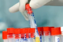 Tiêu chuẩn chẩn đoán nhiễm trùng tiểu ở thai phụ