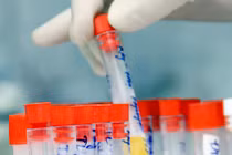 Tiêu chuẩn chẩn đoán nhiễm trùng tiểu ở thai phụ