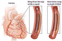 Cách chữa động mạch vành