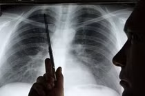 Kéo dài thời gian sống cho bệnh nhân ung thư phổi
