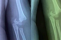 Vụ trẻ mầm non bị gãy tay: Phòng GD&ĐT nói gì?