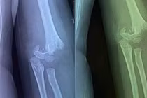 Vụ trẻ mầm non bị gãy tay: Phòng GD&ĐT nói gì?