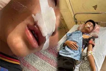 Nam sinh bị bạn học cùng trường đánh nhập viện ở Hà Nội