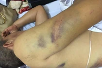 Lộ nguyên nhân thầy dạy lái ở Hải Dương bị đánh gãy xương sườn?