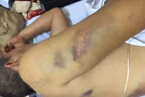 Lộ nguyên nhân thầy dạy lái ở Hải Dương bị đánh gãy xương sườn?