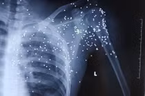 Thái Bình: Kẻ lạ mặt nổ súng hoa cải vào 1 thanh niên tại trạm BOT