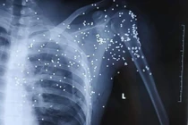 Thái Bình: Kẻ lạ mặt nổ súng hoa cải vào 1 thanh niên tại trạm BOT