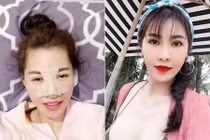 Quế Vân “đập mặt” lần 2 sau 3 tháng phẫu thuật thẩm mỹ