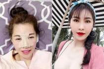 Quế Vân “đập mặt” lần 2 sau 3 tháng phẫu thuật thẩm mỹ