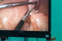 Mổ ruột thừa, bệnh nhân tử vong bất thường?