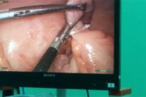 Mổ ruột thừa, bệnh nhân tử vong bất thường?