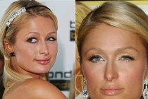 Sao Hollywood khổ sở vì mắt lác