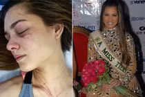 Hoa hậu Trái Đất Venezuela 2012 bị đánh chấn thương cột sống