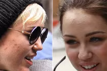 Sao khổ sở vì làn da tàn tệ