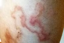 Kinh dị loài giun lươn ký sinh bò dưới da người