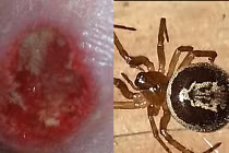 Rùng mình với vết cắn của loài nhện độc nhất nước Anh