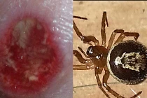 Rùng mình với vết cắn của loài nhện độc nhất nước Anh