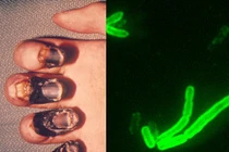 Tận mục vi khuẩn gây ra Cái chết Đen