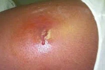 Tận mục siêu vi khuẩn đáng sợ đang xâm lấn nhà dân