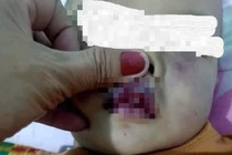 Nghi vấn điểm giữ trẻ không phép bạo hành dã man trẻ 18 tháng tuổi