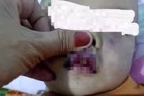 Nghi vấn điểm giữ trẻ không phép bạo hành dã man trẻ 18 tháng tuổi