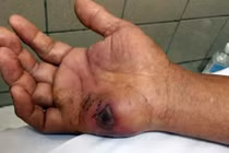 Liên tiếp xảy ra rắn độc cắn người, gây tử vong ở Lạng Sơn