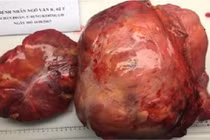 Cắt bỏ khối u khủng chiếm trọn ổ bụng cùng nửa đại tràng phải