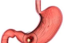 Đại tiện phân đen có nguy hiểm hay không?