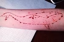 Nữ sinh 15 tuổi nhập viện vì tham gia “trò chơi tự tử” đáng sợ