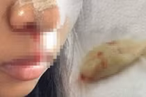 Sửa mũi thất bại, cô gái 3 ngày phải thở bằng miệng