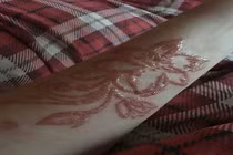 Cô gái trẻ bị bỏng hóa học, mang sẹo cả đời vì xăm hình Henna