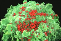 Vaccine AIDS giúp 5 bệnh nhân ‘sạch’ HIV trong 7 tháng