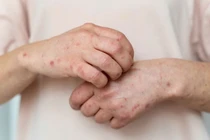 Nhận biết bệnh giang mai qua dấu hiệu ở từng giai đoạn