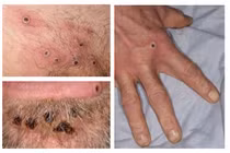 Video: Nguy cơ cao bệnh đậu mùa khỉ xâm nhập, Việt Nam ứng phó sao?