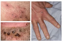 Video: Nguy cơ cao bệnh đậu mùa khỉ xâm nhập, Việt Nam ứng phó sao?