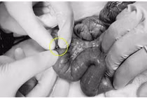 Video: Nuốt loại đồ chơi xếp hình quen thuộc, trẻ ba tuổi thủng ruột