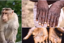 Video: Xem xét công bố tình trạng khẩn cấp toàn cầu về bệnh đậu mùa khỉ