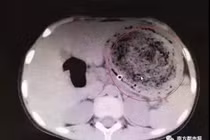 Lạ: Bé gái nghiện nhai tóc với búi tóc 1,5kg trong bụng