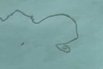 Thấy đau đầu, ghê rợn phát hiện con vật dài 12cm sống trong não