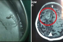 Người đàn ông đau đầu 30 năm, tá hỏa... thứ "ngoe nguẩy" trong não