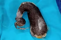 Chuyện lạ độc: Bé gái ăn cả cân tóc, lý do nhện hung dữ...